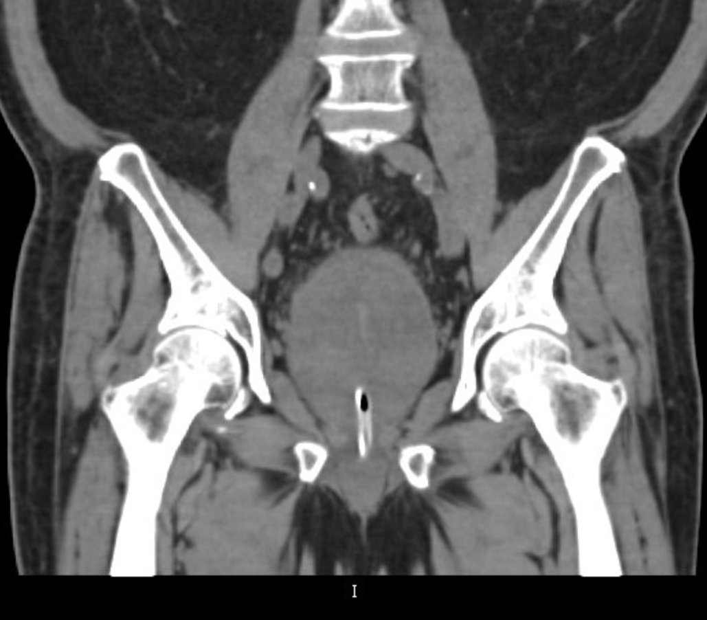 Tomografía Coronal